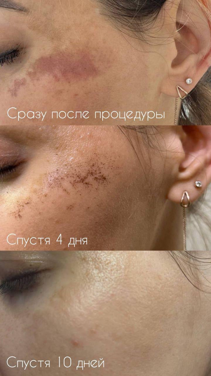 DuoSmooth 2-in-1 Diode Laser + IPL System