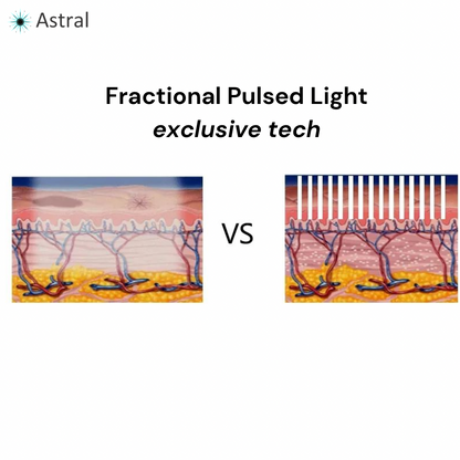 APEX™ 10D Professional Intense Pulsed Light System