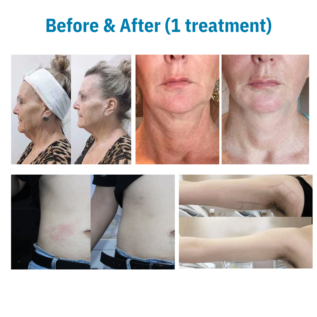 360 Ultra Formation Professional HIFU Machine for Body & Face