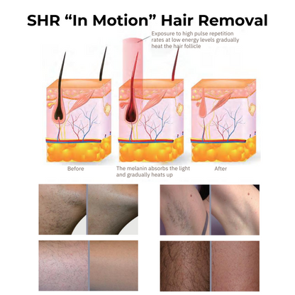 DermaLaze™ Delicate PRO 3 in 1 E-Light Skin Rejuvenation System