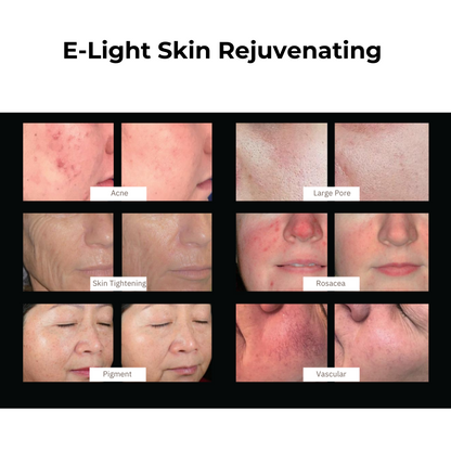 DermaLaze™ Delicate PRO 3 in 1 E-Light Skin Rejuvenation System