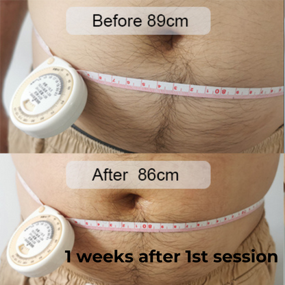 SculptAssure 1060nm Diode Laser Weight Loss Machine