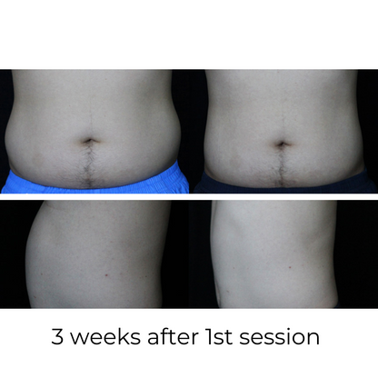 SculptAssure 1060nm Diode Laser Weight Loss Machine