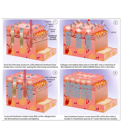 CoolPare EXPERT Fractional CO2 Laser