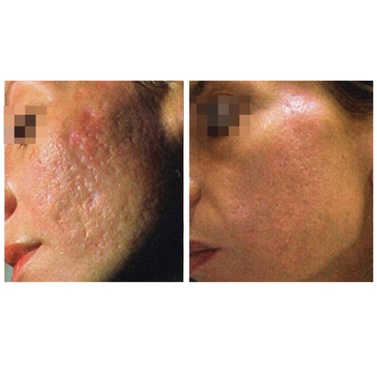 CoolPare EXPERT Fractional CO2 Laser