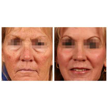 CoolPare EXPERT Fractional CO2 Laser
