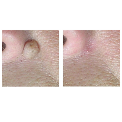 CoolPare EXPERT Fractional CO2 Laser