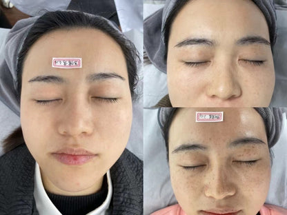 PicoPretty® Picosecond Laser - Complete Pigment Solution