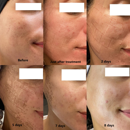 SmartPulse™ COOL Professional CO2 Fractional Laser