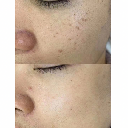 PicoElim™ Tattoo Removal Laser Spot Master